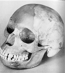 The Piltdown Man skull